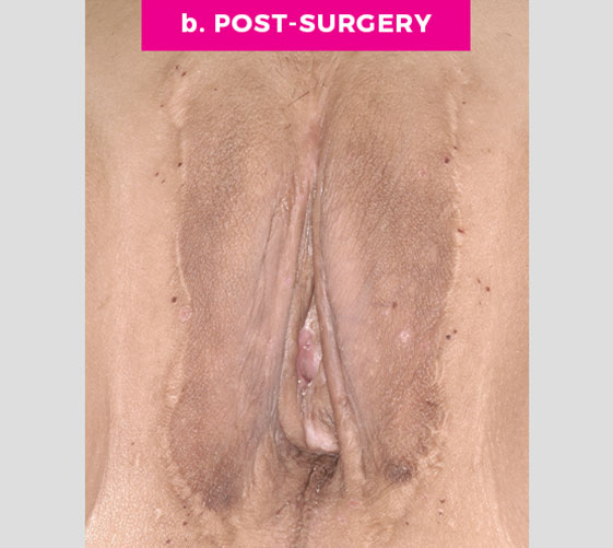 MALE-TO-FEMALE SEX REASSIGNMENT REVISIONS Patient 1 After