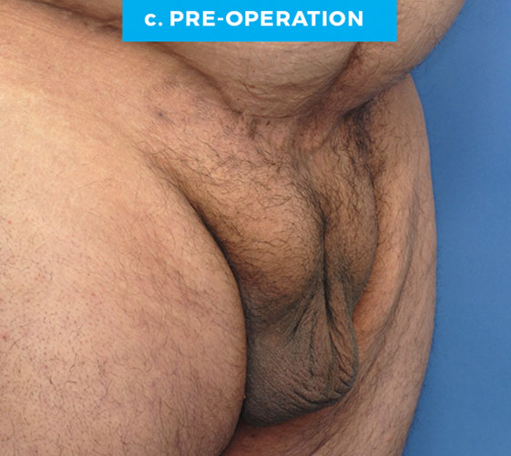 MALE GENITAL RECONSTRUCTION Patient 2 Before 2