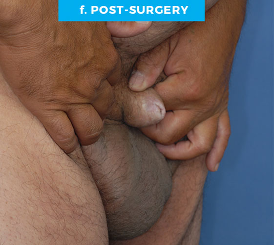MALE GENITAL RECONSTRUCTION Patient 2 After 3
