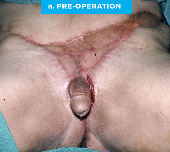 male-11-a MALE GENITAL RECONSTRUCTION Patient 11 Before