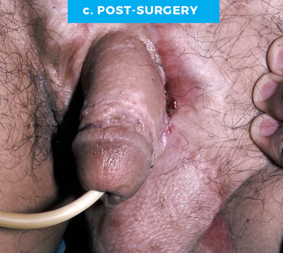 male-11-c MALE GENITAL RECONSTRUCTION Patient 11 Before 3