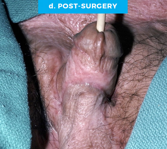 male-11-d MALE GENITAL RECONSTRUCTION Patient 11 After