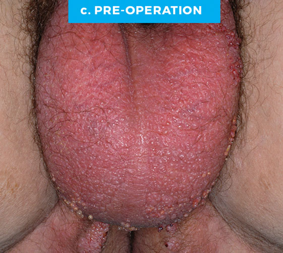 MALE GENITAL RECONSTRUCTION Patient 10 Before 3