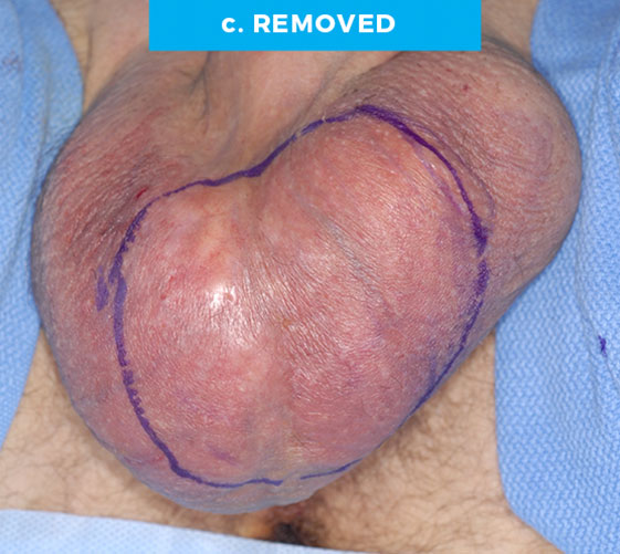male-p12-c MALE GENITAL RECONSTRUCTION Patient 12 Before 3