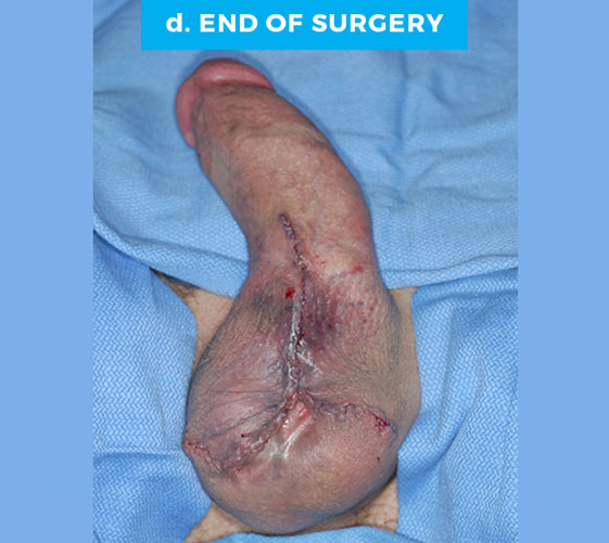 male-p12-d MALE GENITAL RECONSTRUCTION Patient 12 After
