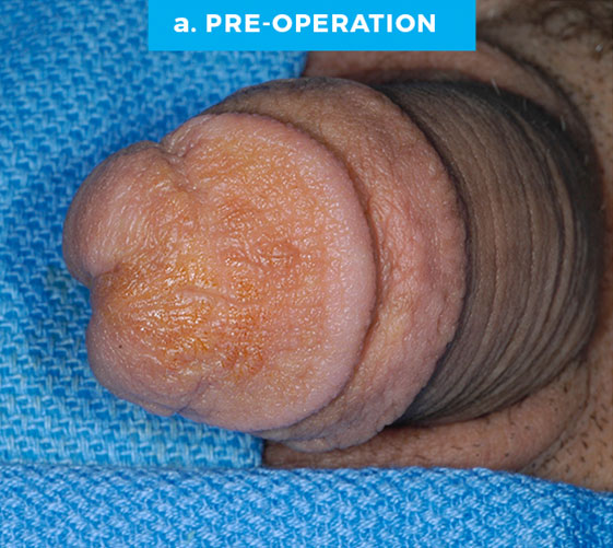 MALE GENITAL RECONSTRUCTION Patient 13 Before