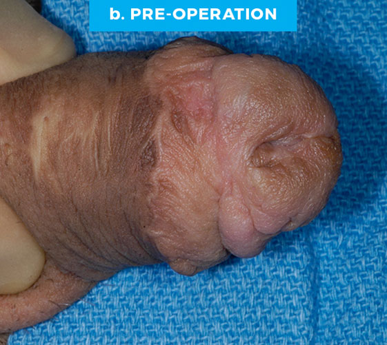 MALE GENITAL RECONSTRUCTION Patient 13 Before 2