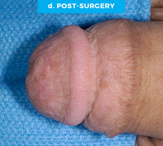 MALE GENITAL RECONSTRUCTION Patient 13 After