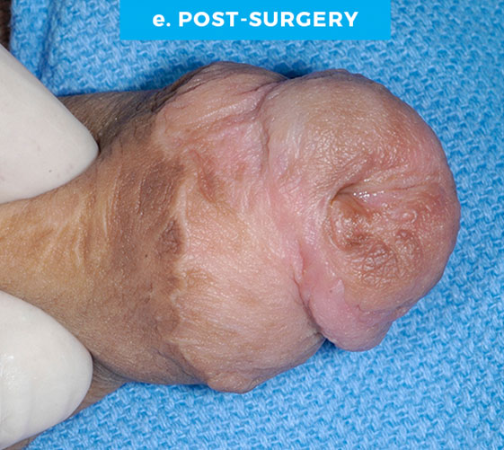 MALE GENITAL RECONSTRUCTION Patient 13 After 2