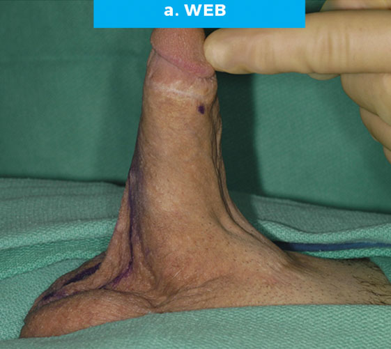 PENOSCROTAL WEBBING Patient 1 Before