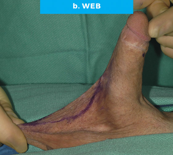 PENOSCROTAL WEBBING Patient 1 Before 3
