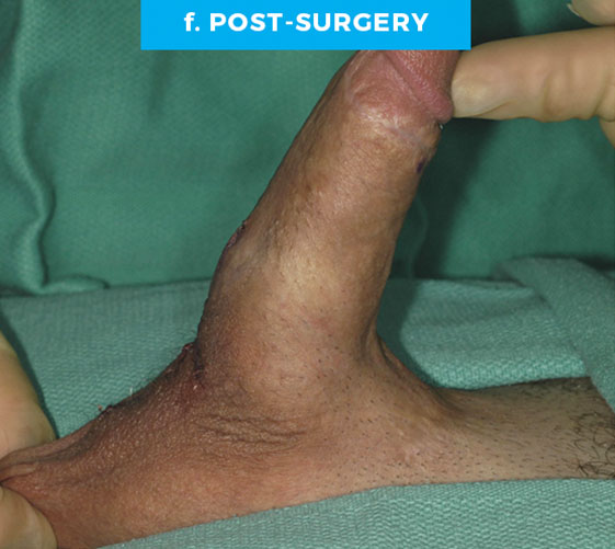 PENOSCROTAL WEBBING Patient 1 After 3