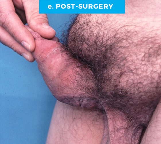 male-p8-e MALE GENITAL RECONSTRUCTION Patient 8 After 2