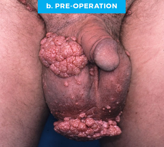 male-p8_b MALE GENITAL RECONSTRUCTION Patient 8 Before 2