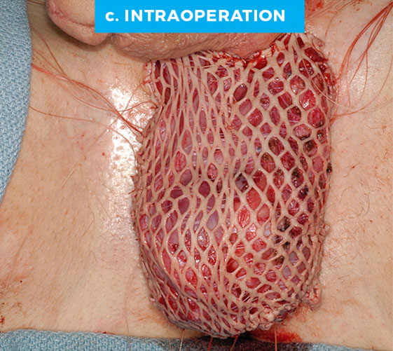 male-p9-c MALE GENITAL RECONSTRUCTION Patient 9 during