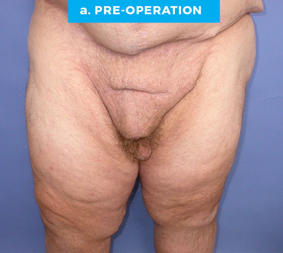 male-patient6-a MALE GENITAL RECONSTRUCTION Patient 6 Before
