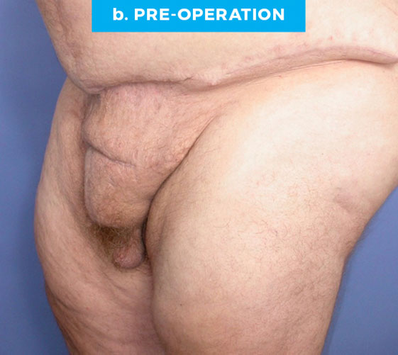 male-patient6-b MALE GENITAL RECONSTRUCTION Patient 6 Before 2