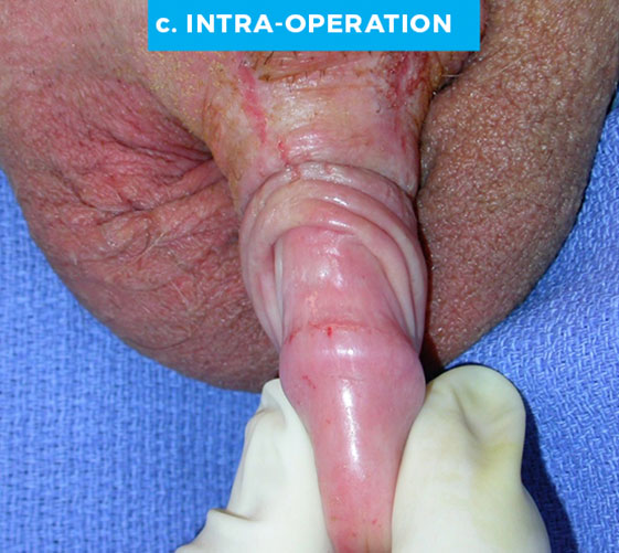 male-patient6-c MALE GENITAL RECONSTRUCTION Patient 6 Before 3