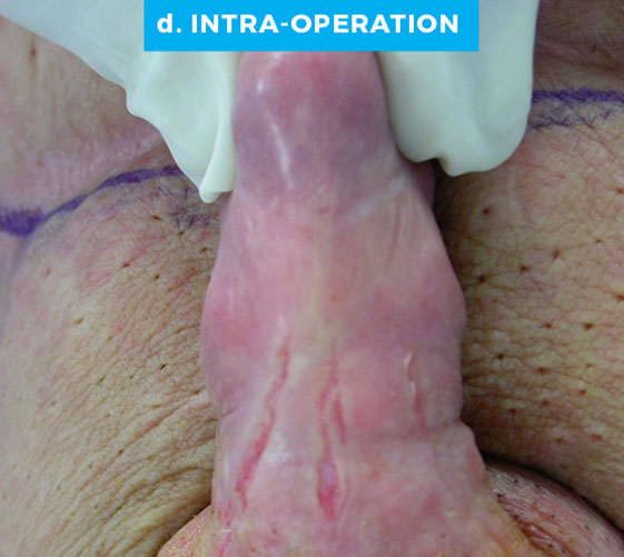 male-patient6-d MALE GENITAL RECONSTRUCTION Patient 6 After