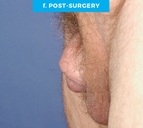 male-patient6-f MALE GENITAL RECONSTRUCTION Patient 6 After 3