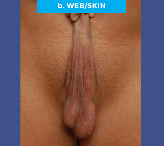male-web-2b PENOSCROTAL WEBBING Patient 2 Before 3