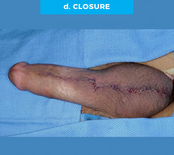 PENOSCROTAL WEBBING Patient 2 After 4