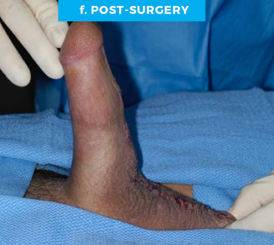 PENOSCROTAL WEBBING Patient 2 After 2