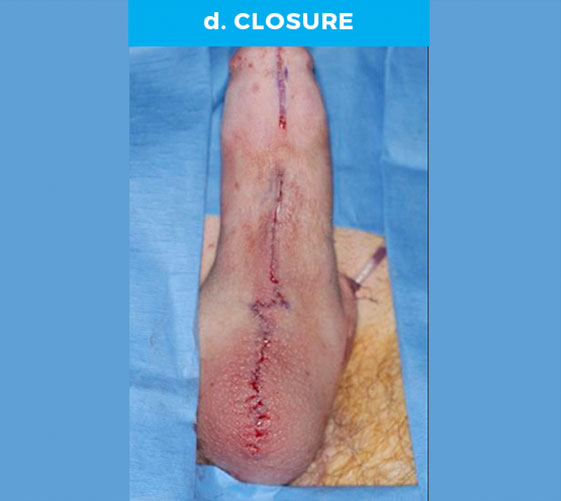 PENOSCROTAL WEBBING Patient 3 After 4