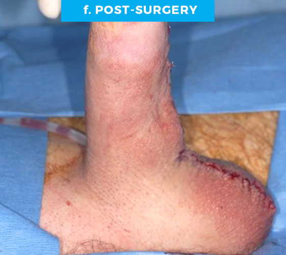 PENOSCROTAL WEBBING Patient 3 After 2