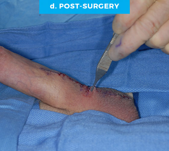 male-web-p4-d PENOSCROTAL WEBBING Patient 4 Before 4