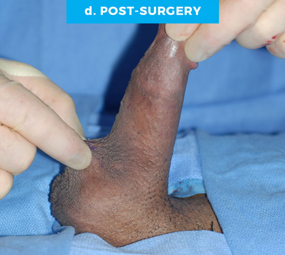 PENOSCROTAL WEBBING Patient 5 After