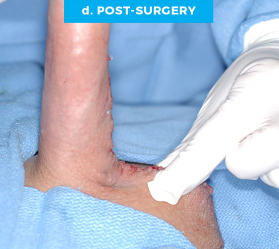 male-web-p6-d PENOSCROTAL WEBBING Patient 6 Before 3