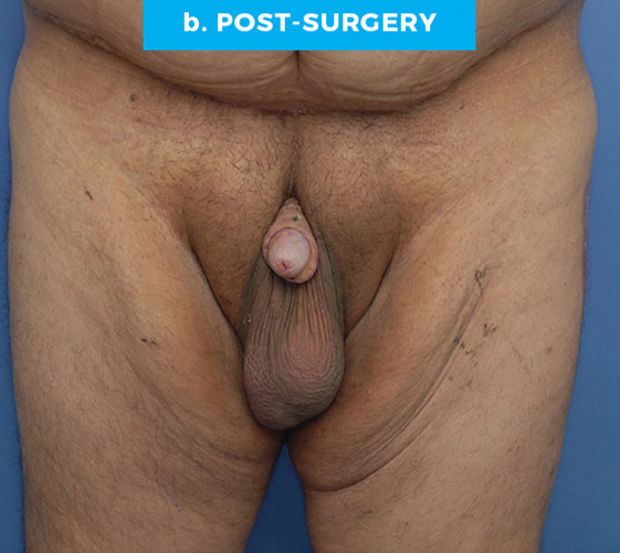MALE GENITAL RECONSTRUCTION Patient 2 After