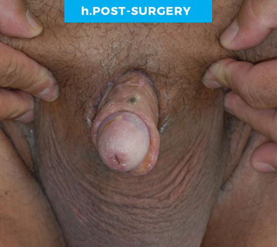 MALE GENITAL RECONSTRUCTION Patient 2 After 4