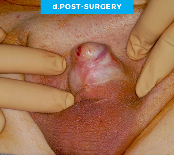 MALE GENITAL RECONSTRUCTION Patient 4 After 2