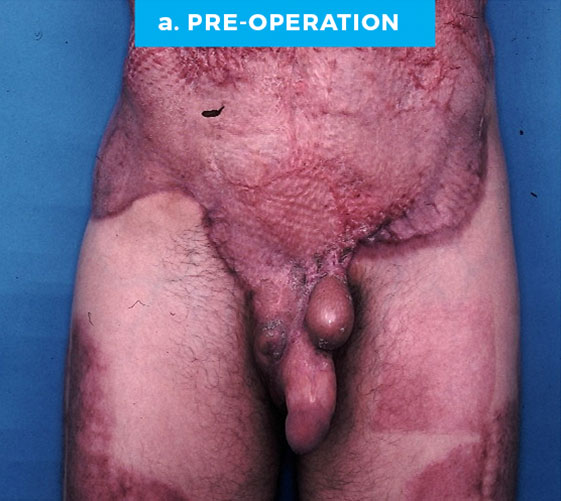 MALE GENITAL RECONSTRUCTION Patient 7 Before