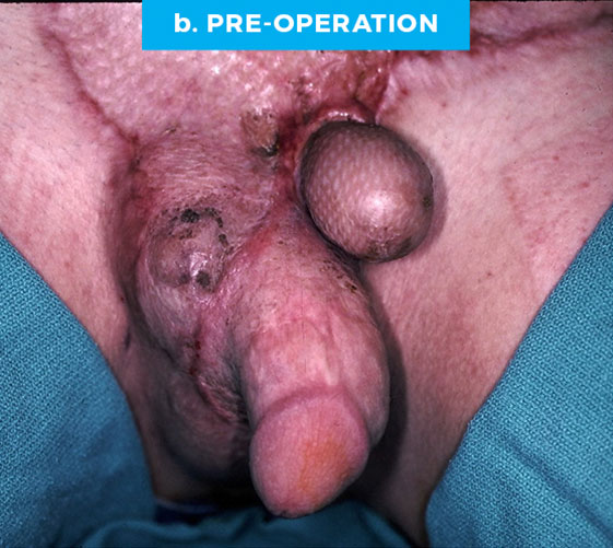 MALE GENITAL RECONSTRUCTION Patient 7 Before 2