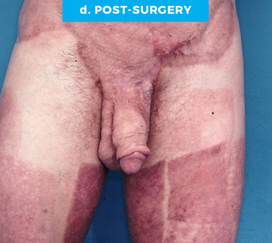 MALE GENITAL RECONSTRUCTION Patient 7 After