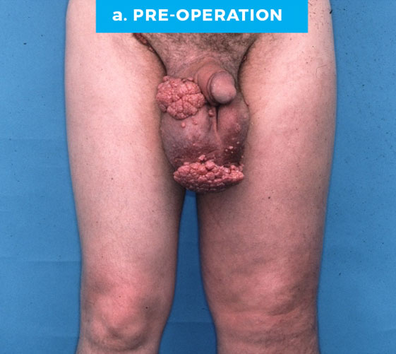 male_p8_a MALE GENITAL RECONSTRUCTION Patient 8 Before