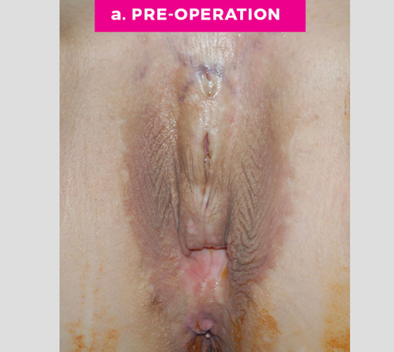 MALE-TO-FEMALE SEX REASSIGNMENT REVISIONS Patient 2 Before