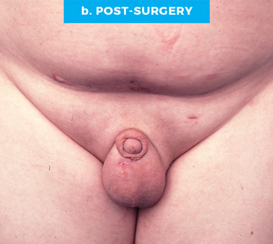 BURIED/HIDDEN PENIS CORRECTIVE SURGERY Patient 7 After