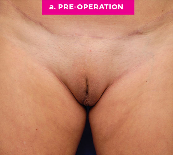 LABIA MAJORA REMODELING Patient 1 Before