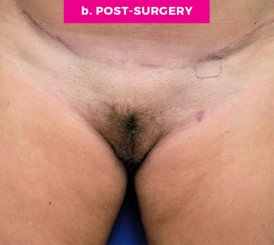 LABIA MAJORA REMODELING Patient 1 After