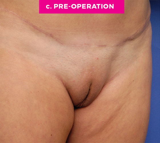 LABIA MAJORA REMODELING Patient 1 Before 2