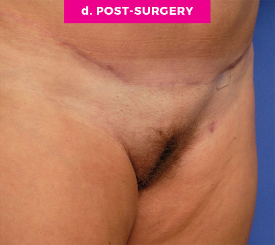 LABIA MAJORA REMODELING Patient 1 After 2