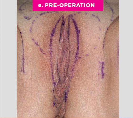 LABIA MAJORA REMODELING Patient 1 Before 3