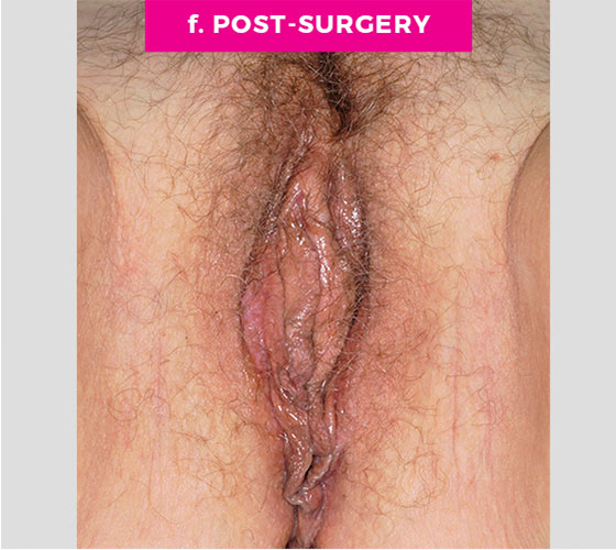 LABIA MAJORA REMODELING Patient 1 After 3