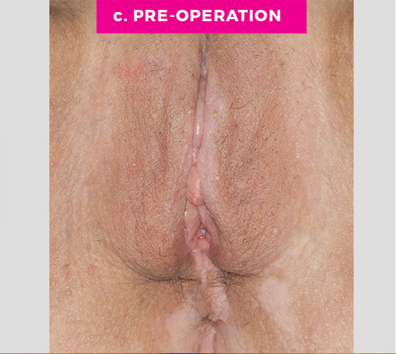 LABIA MAJORA REMODELING Patient 11 Before 2