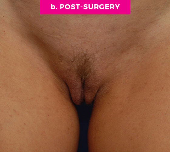 LABIA MAJORA REMODELING Patient 14 After