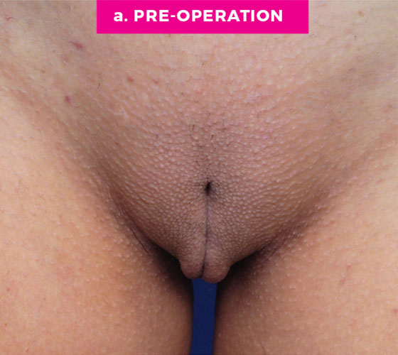 LABIA MAJORA REMODELING Patient 2 Before